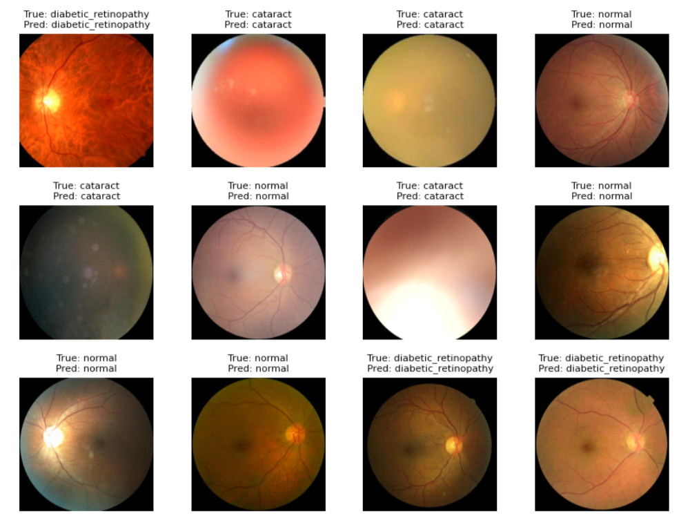AI-Powered Retinal Disease Detection with Deep Learning & Computer Vision Pipeline